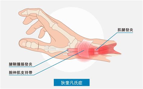 媽媽手是什麼？認識症狀、原因及舒緩治療方法，改善媽媽手 維力骨科診所