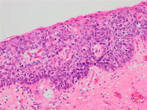 Pathology Outlines Squamous Cell Carcinoma