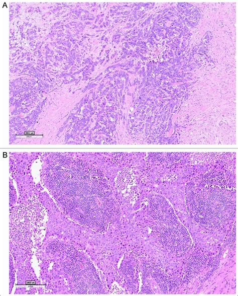 Tumor Infiltrating Lymphocytes Tils Improve Prognosis In Patients