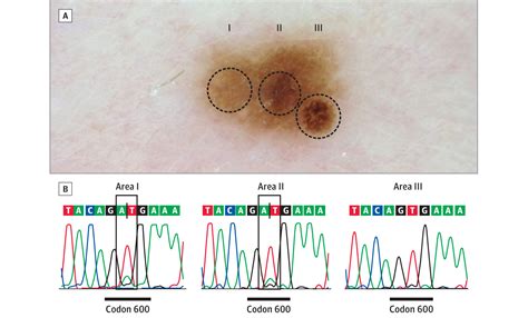 Braf Wild Type Melanoma In Situ Arising In A Braf V E Mutant