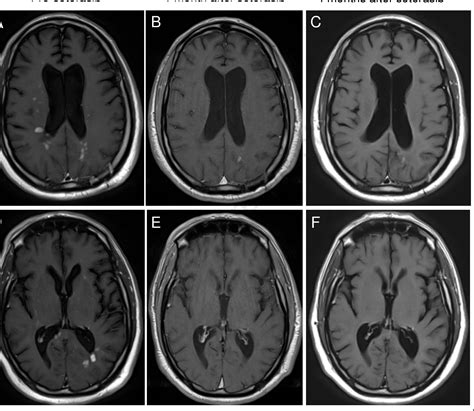 Figure From Remarkable Intracranial Response To Sotorasib In A