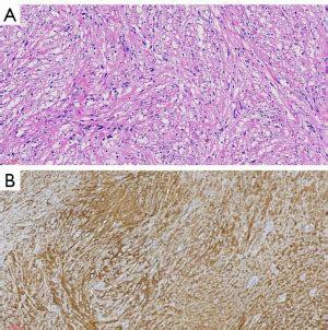 Laparoscopic Resection Of Gastric Schwannoma A Case Description Fan