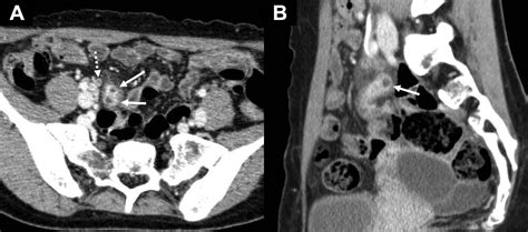 Meckels Diverticulum Xray