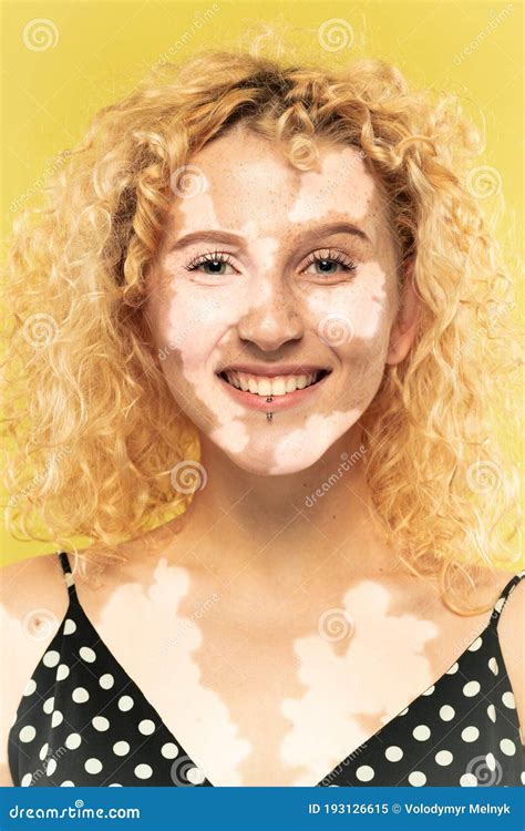 Studio Portrait of Caucasian Woman with Vitiligo Skin, Beauty Concept Stock Image - Image of ...