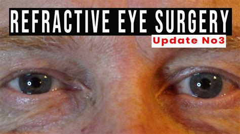 Refractive Eye Surgery Update 3 Youtube