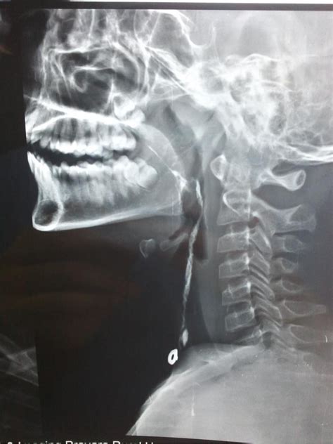 Figure 2 From The Complete Second Branchial Cleft Fistula A Case Report Semantic Scholar