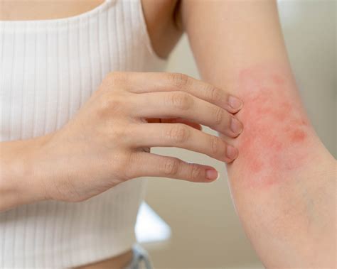 Flexural Eczema Triggers Understanding And How To Prevent Them