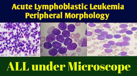 acute lymphoblastic leukemia   medicine  vincent