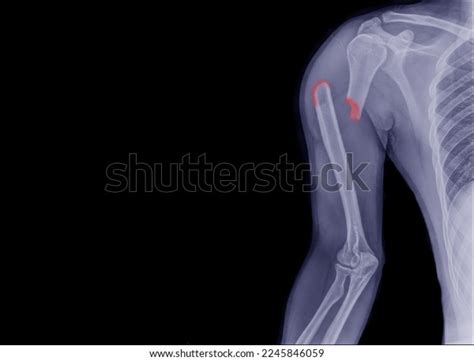 Forearm X-ray Showing Fracture Upper Arm Stock Photo 2245846059 ...