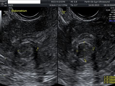 Pelvic Ultrasound - POGU