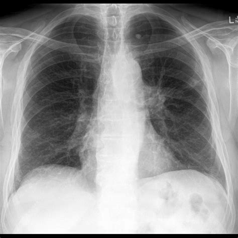 Normal Radiograph Of Chest 6