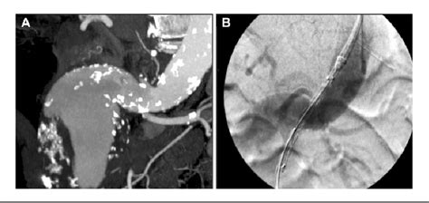 Figure 3 From Push Up Technique And Anatomical Deployment With The