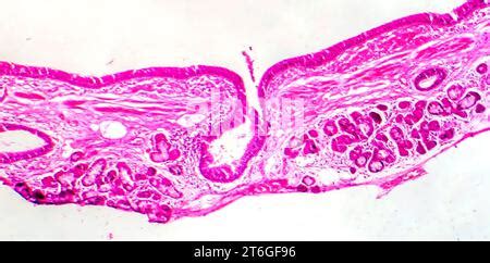 Fotomicrograf A De Metaplasia Escamosa Epitelial Bronquial Mostrando