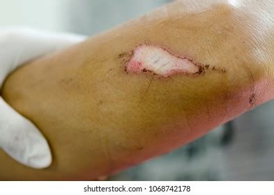 Skin Abrasion Images, Stock Photos & Vectors | Shutterstock