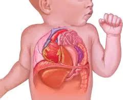 Congenital Diaphragmatic Hernia Cause Symptoms Treatment