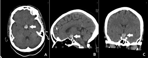 Hyperdense Suprasellar Mass An Unusual Radiological Presentation Of