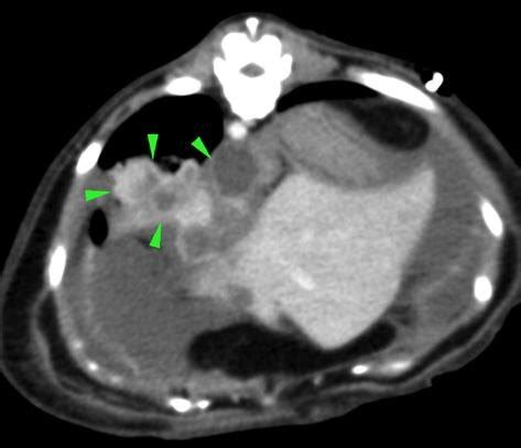 Post Contrast Transverse Ct Image In Soft Tissue Algorithm Amorphous