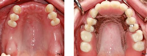 Removable Partial Denture For Maxillary Incisors Dentistry Articles