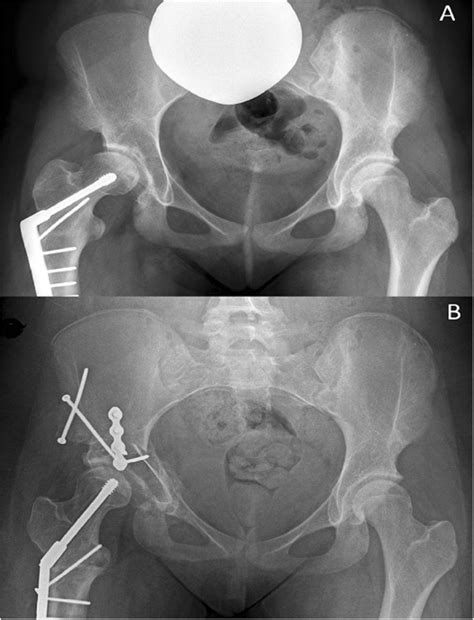 Example Of Preoperative A And Postoperative B Radiographs Following