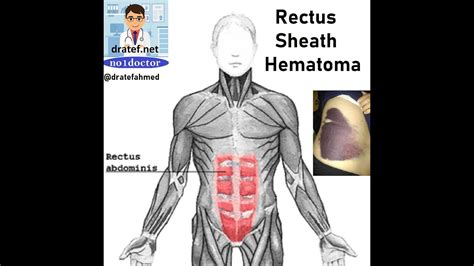 Rectus Sheath Hematoma Causes Signs And Symptomes Treatment