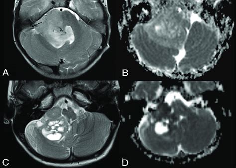 Differential Diagnoses In Posterior Fossa Tumors Involving The Foramen Download Scientific