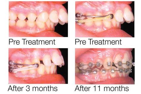 Carriere Distalizer Db Orthodontics Limited