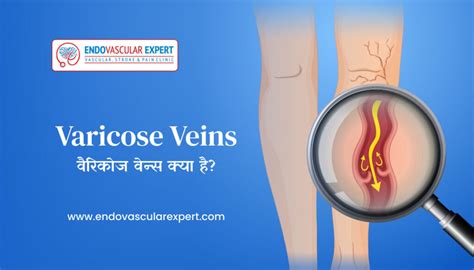 Varicose Veins In Hindi वैरिकोज वेन्स क्या है Endovascularexpert Clinic