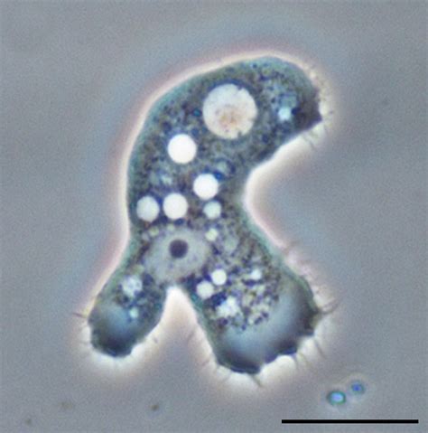 What Is Acanthamoeba Infection Storymd