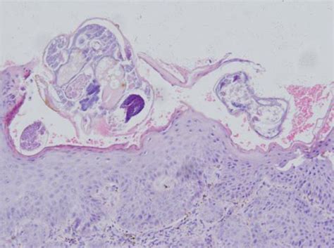 Skin Biopsy From Glans Showed Hyperkeratosis Acanthosis Of Stratum