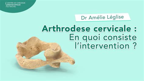 Arthrodèse cervicale En quoi consiste lintervention Dr Amélie