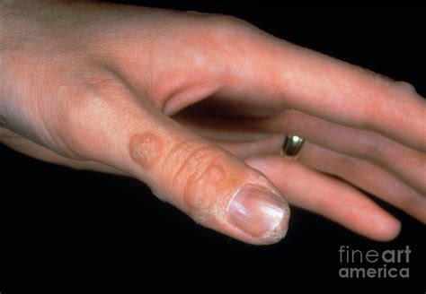 Warts On Finger Photograph By St Bartholomews Hospitalscience Photo