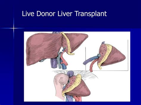 PPT - Liver Transplantation for Alcoholic Liver Disease PowerPoint Presentation - ID:150954