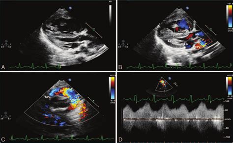 Total Anomalous Pulmonary Venous Return Without Obstruction