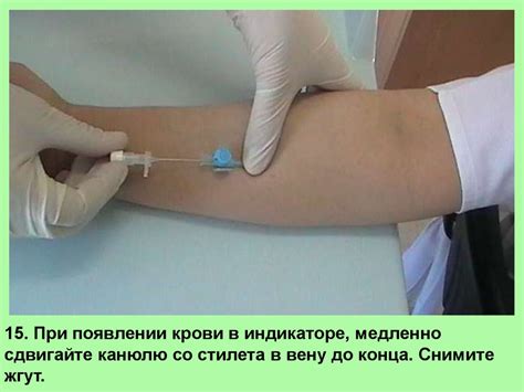Правила постановки периферического венозного катетера - презентация онлайн