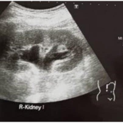 Abdominal ultrasound findings. | Download Scientific Diagram