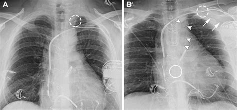 Radiology Of Intra Aortic Balloon Pump Catheters Radiology