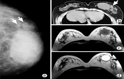 乳腺影像学表现 医学影像图医学图库