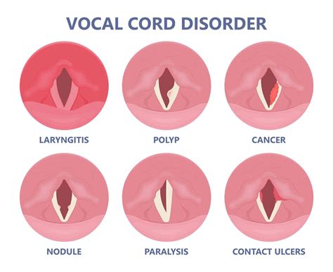 How to actually fix a lost voice, according to science (hint: lemon and