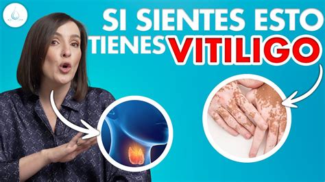 Que Es Y Como Se Cura El Vitiligo Drapilarochoa Dermatologa Youtube