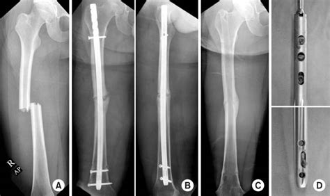 Comment Traiter Les Fractures Techniques Moyens Et Volution