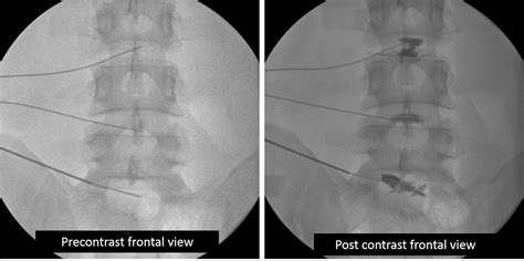 Posterior annular tear with facet joint injection – Radiology Cases