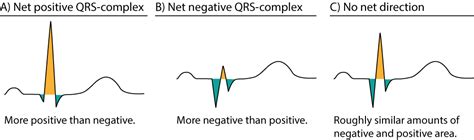 The Qrs Complex Ecg Features Of The Q Wave R Wave S Wave And Duration