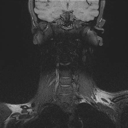 Vertebral Artery Dissection Radiology Case Radiopaedia Org