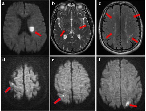 Patient 2. a-c Brain MRI performed after the first stroke. a MRI DWI ...