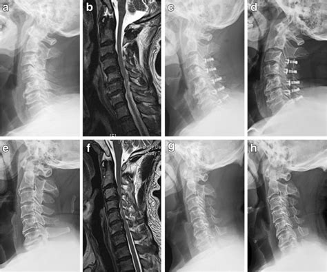 Comparison Of Cervical Sagittal Imaging Parameters Between Two Surgical