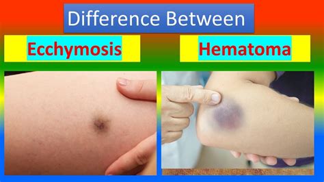 Ecchymosis Vs Bruise