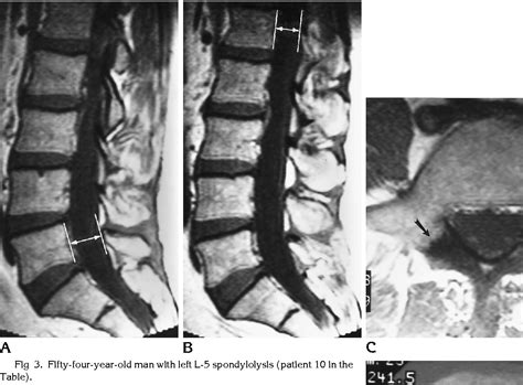Spondylolysis Mri