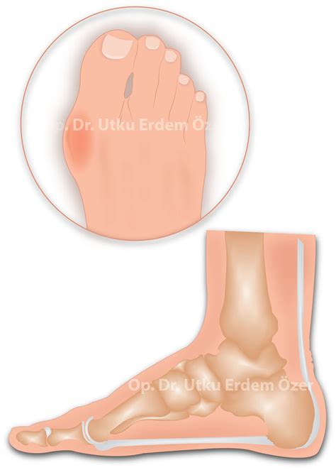 Ayak Başparmak Kireçlenmesi Halluks Rigidus Nedir