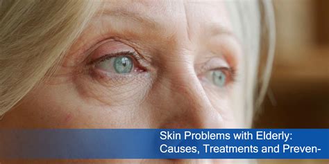 Skin Problems With Elderly Causes Treatments And Prevention