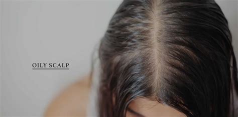 Oily Scalp - Ensoul Medical Clinic